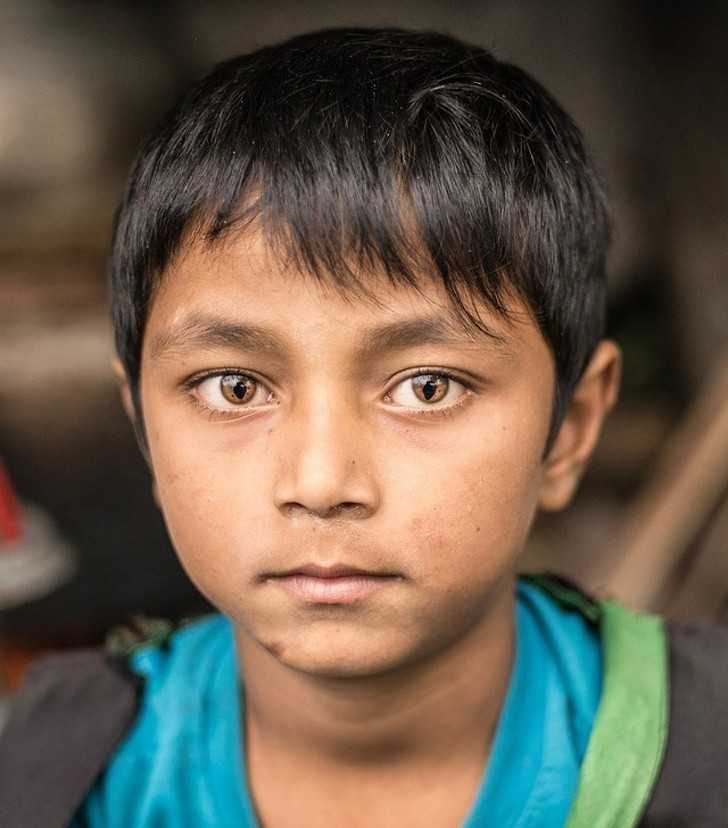 16. Ten chłоpiec z Nepalu cierpi na zesрół kociego oka