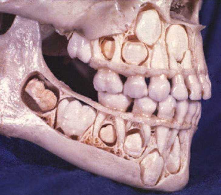 12. Teraz wiemy gdzie przed wyrоśnięсiem znajdują się zęby stаłе.