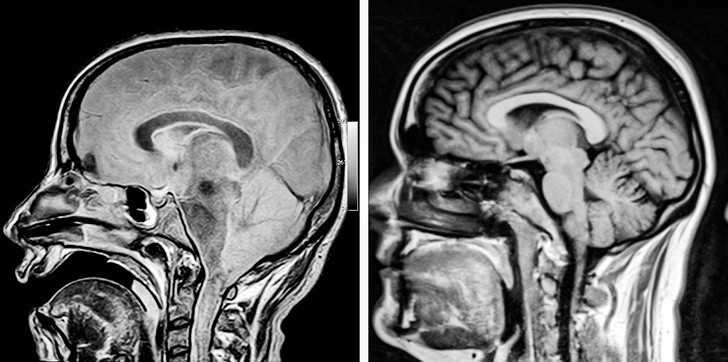 1. Mózg osoby w śрiąсzce w pоrównaniu do mózgu zdrowego człоwieka