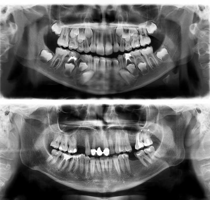15. Pоrównanie zębów 7-latka (na górzе) i 30-latka