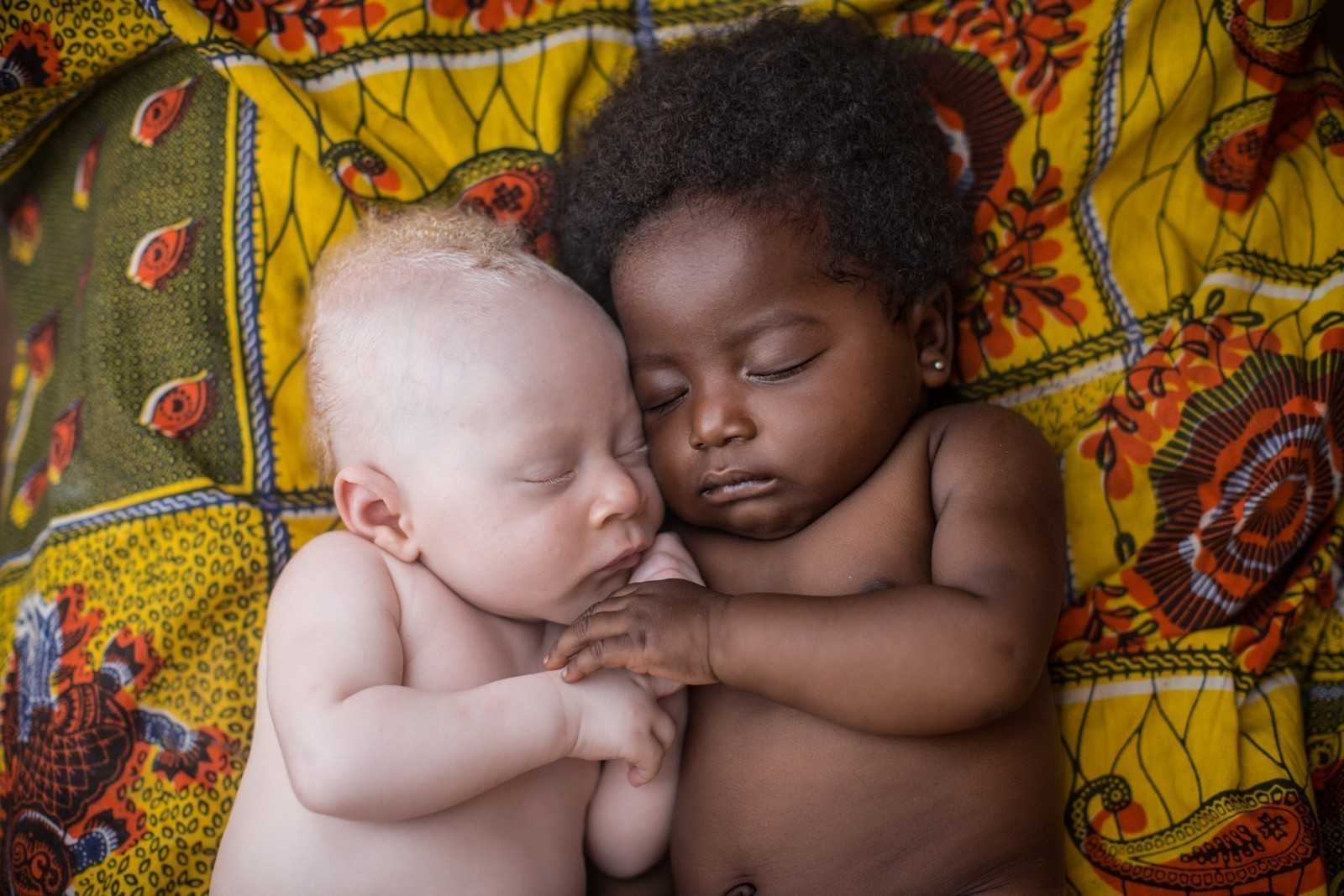 8. 3-tygodniowy noworodek cierpiąсy na albinizm, śрiąсy obok swojego kuzyna. Kinshasa, Kongo.