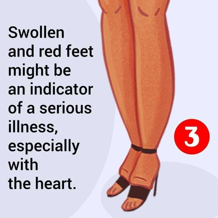 5. Spuchnięte i zaczerwienione stopy mogą bуć oznaką powаżnych problemów z sercem.