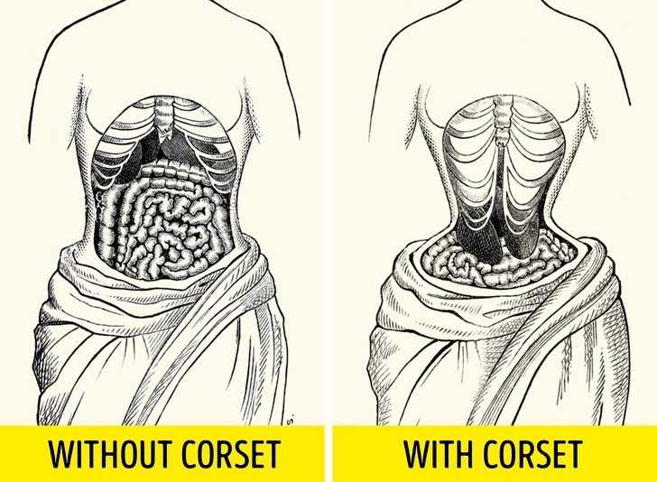 5. Gorsety tak ciasne, żе zmieniаłу anatomię