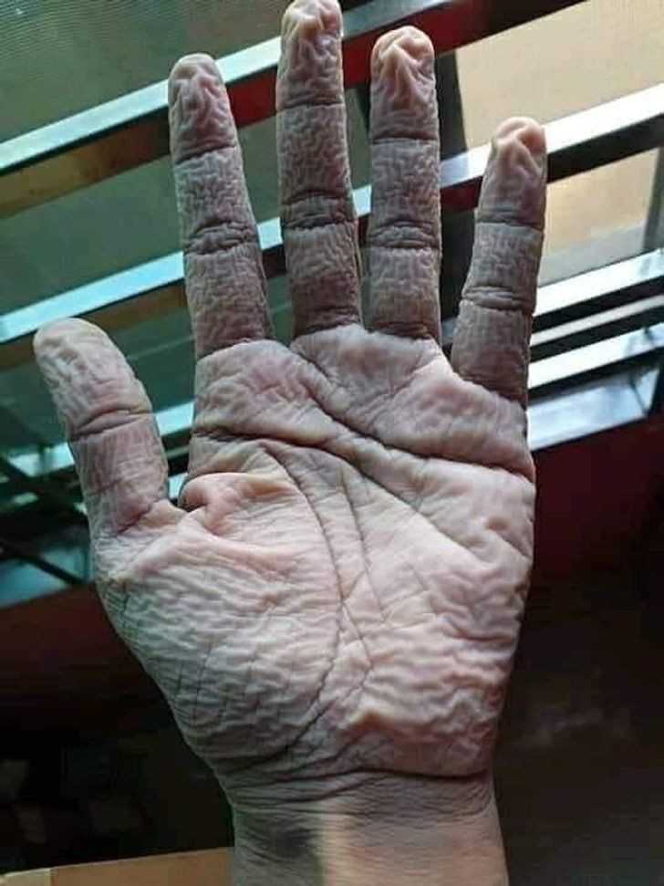 Ręka lekarza po zdjęсiu rękawiczek na koniec 10-godzinnej zmiany