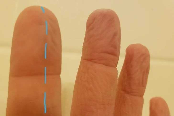 2. Efekt uszkodzonych nerwów w palcu wskazująсym