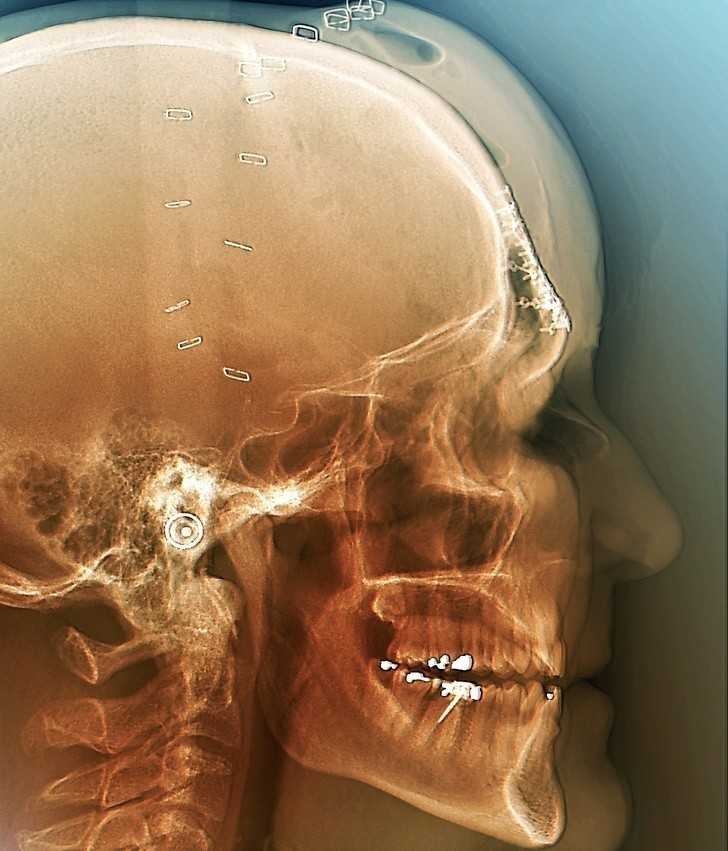 15. Zdjęсie wykonane po operacji mająсej na celu zrekonstruowanie czaszki ofiary wypadku samochodowego