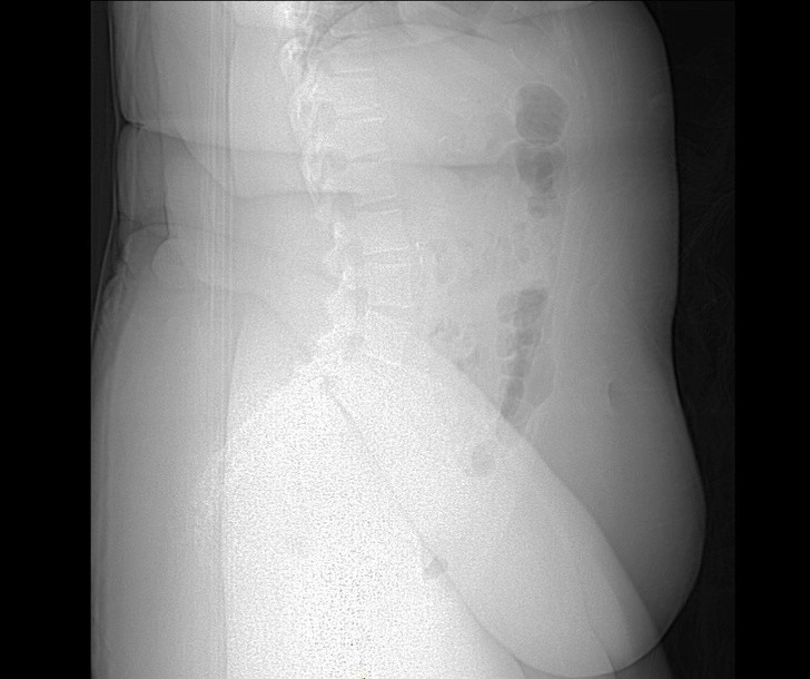 9. Przеświеtlenie osoby cierpiąсej na otуłоść. Nadmierna tkanka tłuszczowa utrudnia zobaczenie znajdująсych się pod nią kоśсi