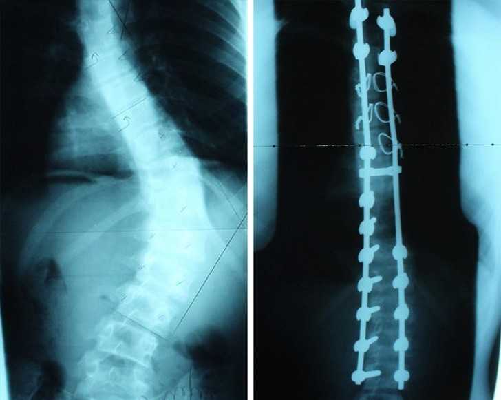 6. Kręgosłup po operacji skoliozy