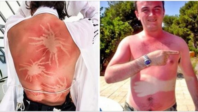 Te zdjęcia przypominają, że nie warto zasypiać na słońcu! Poparzenia słoneczne mogą wyglądać śmiesznie ale są niebezpieczne!