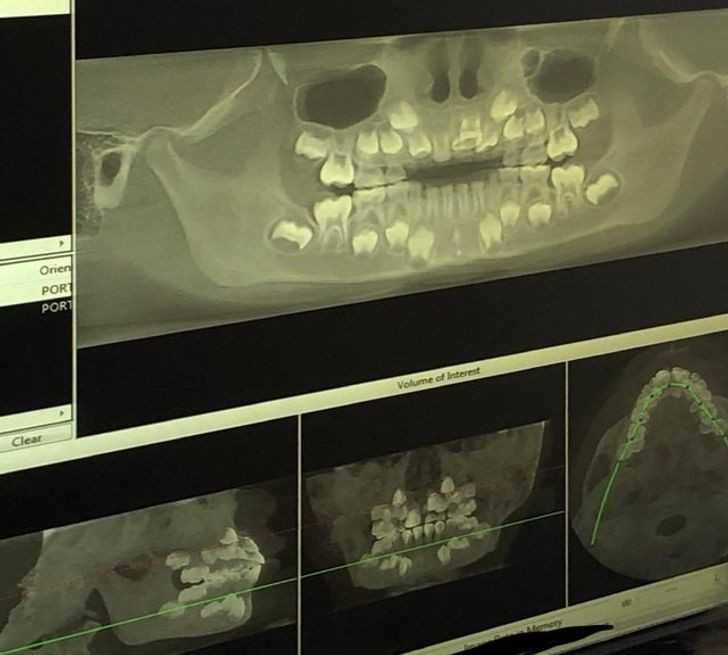 Dentystyczne zdjęсie rentgenowskie pokazująсe niewyrоśnięte zęby u dziecka