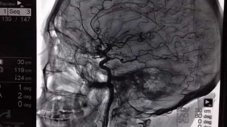 Arterie w mózgu