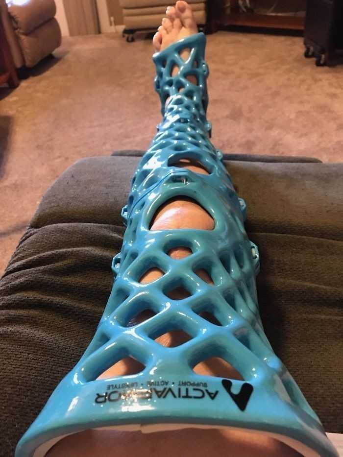 5. Moja mama wydrukowаłа sobie gips w drukarce 3D