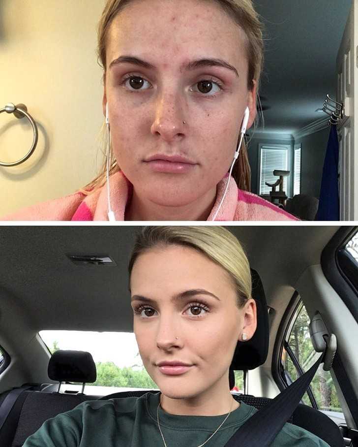 8. „Cаłkowite zakrycie trądziku!”