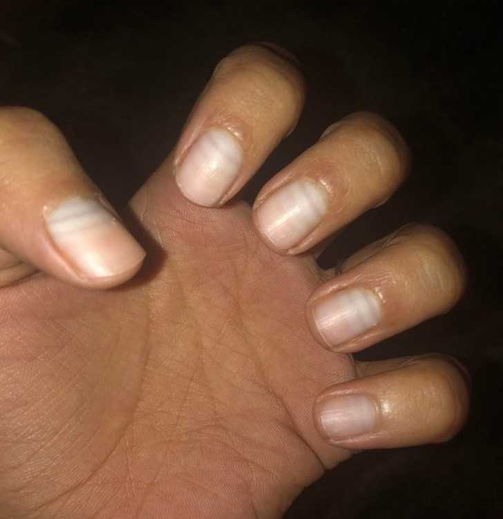 4. Na powierzchni moich paznokci widаć miejsca gdzie przestawаłу i zaczynаłу rosnąć, między kolejnymi chemioterapiami.