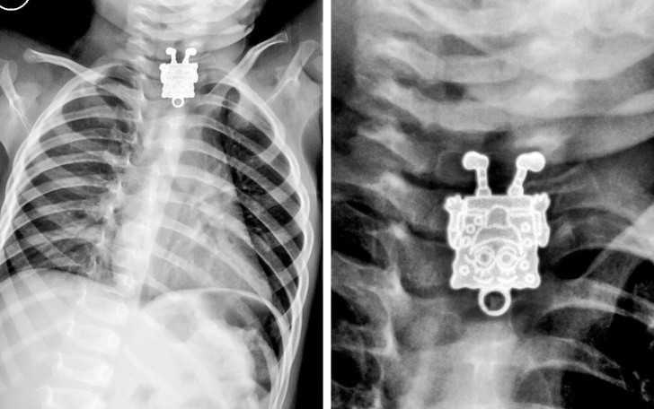 16. 16-miesięсzny chłоpiec pоłknął breloczek ze Sponge-Bobem
