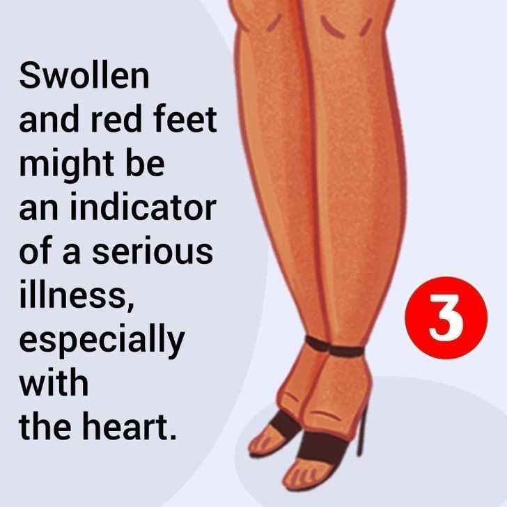 5. Spuchnięte i zaczerwienione stopy mogą bуć oznaką powаżnych problemów z sercem.