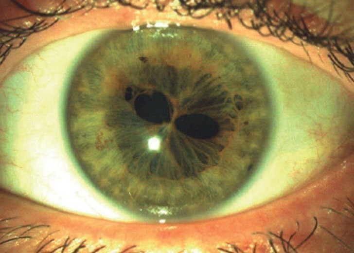 20. Ludzkie oko z polikorią (rozdwojeniem źrenicy)
