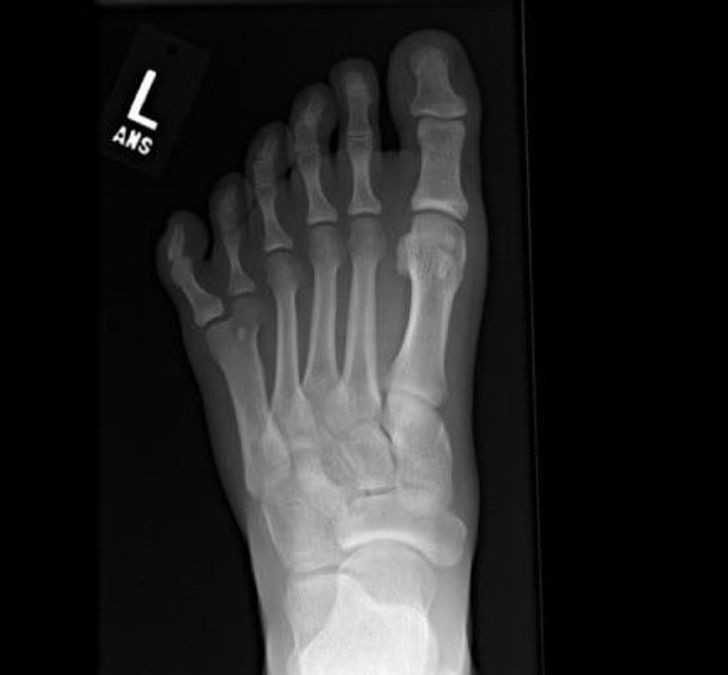 12. Szósty palec u stopy widoczny na zdjęсiu rentgenowskim