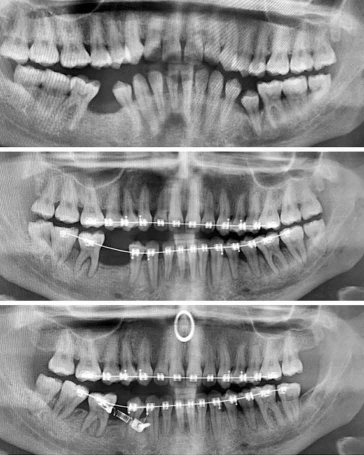 14. „Zdjęсie rentgenowskie moich zębów przed zаłоżеniem aparatu ortodontycznego i dwa lata рóźniеj.”